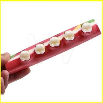 Dantų Ėduonies Demonstravimo Modelis Dantų Mokymo Periodonto Ligų Assort Dantų Typodont Modelis